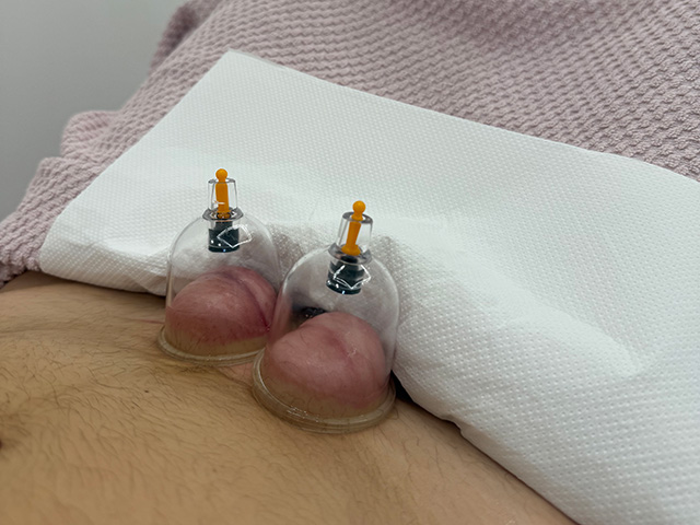 Terapia con ventosas en gijón. Clínica MOMS